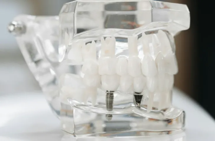 Žandikaulis prieš dantų implantaciją - Pavyzdys