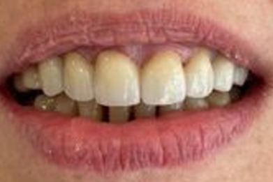 Teeth after whitening - Example 4
