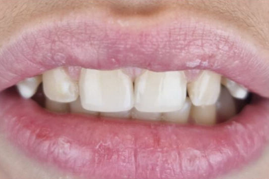 Teeth after whitening - Example 5