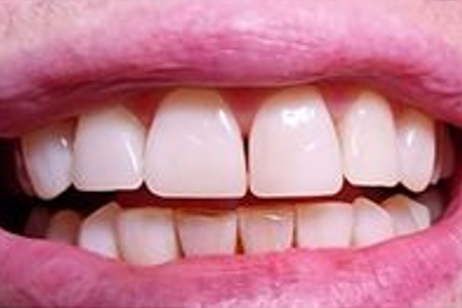 Teeth after whitening - Example 5