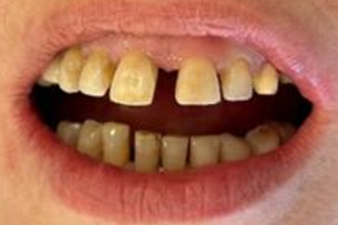 Teeth before whitening - Example 4