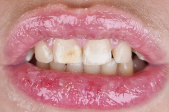 Teeth before whitening - Example 5