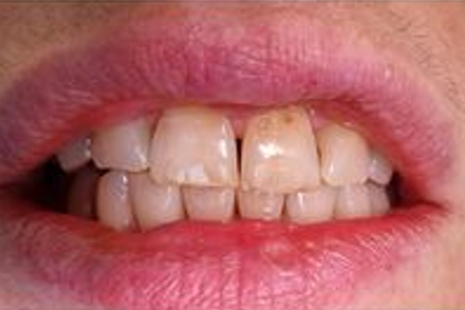 Teeth before whitening - Example 5